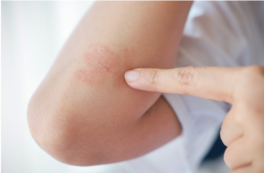 Jangan Sampai Keliru, Ini Perbedaan Psoriasis dan Eksim yang Harus Kamu Tahu